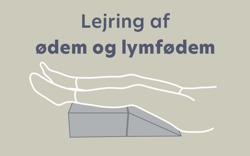 Lejring af ødem og lymfødem – 5 eksempler